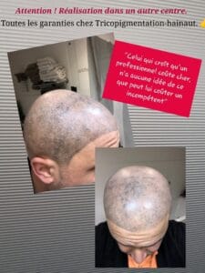 micropigmentation ratée