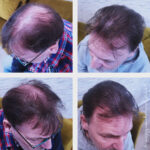 Avant / après d'un effet densité homme réalisé au centre micropigmentation hainaut