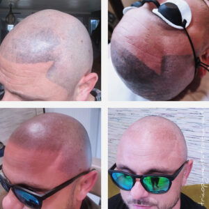 Réparation et détatouage laser d'une tricopigmentation ratée en turquie .