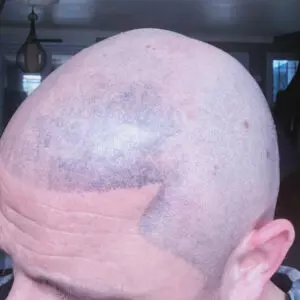 Tricopigmentation ratée, vous voulez éviter les pièges et ce genre de réalisation. centre micropigmentation le spécialiste des réparations et des effets naturels.